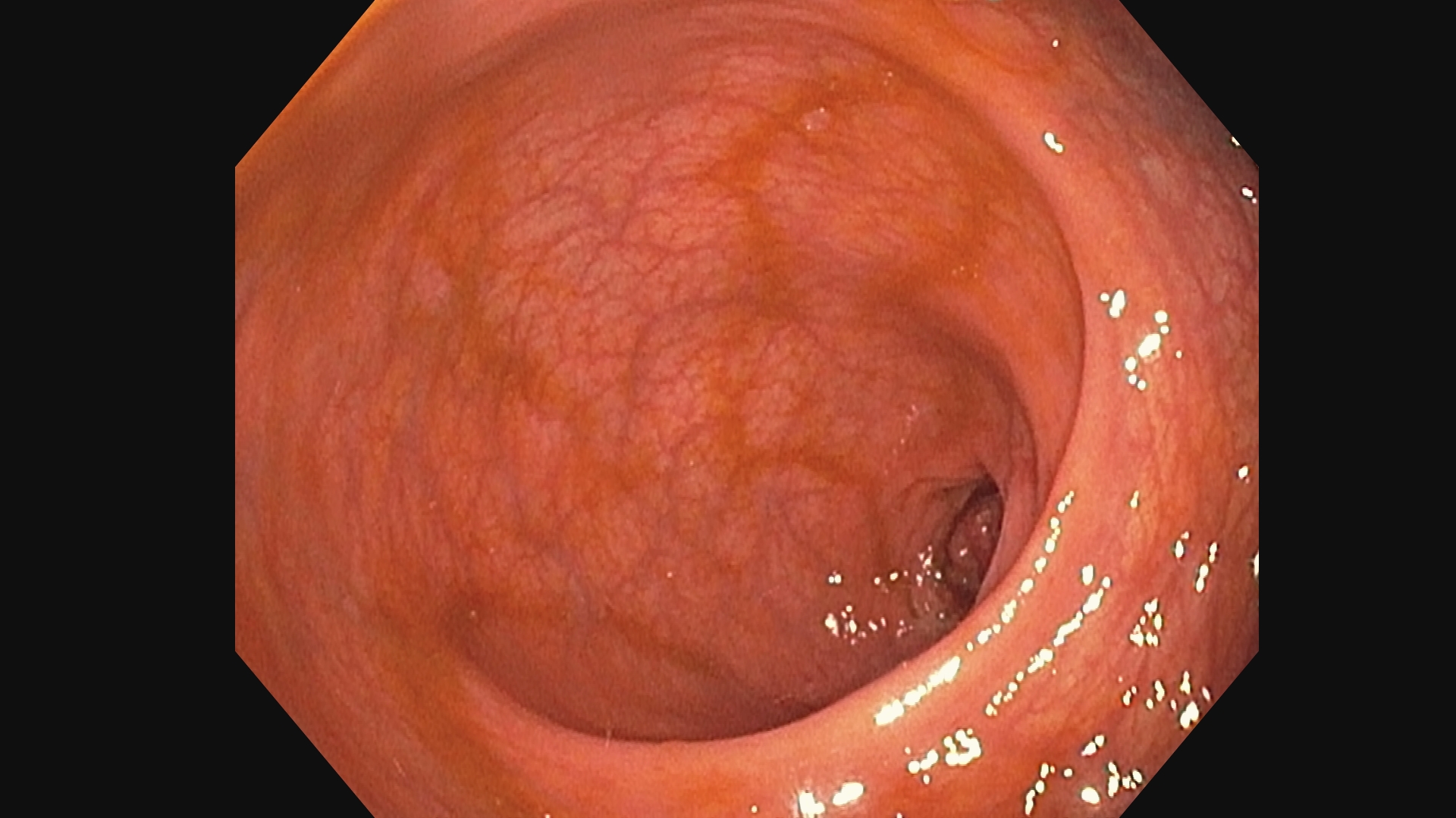 endoscopy_healthy